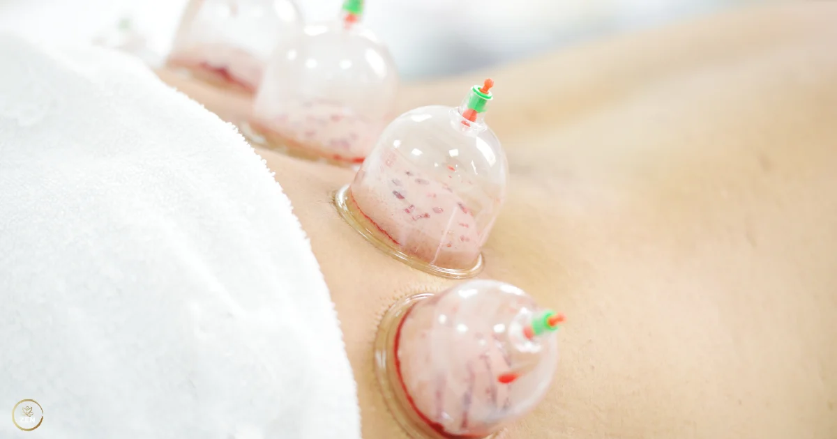 Does Cupping Therapy Actually Work in Abu Dhabi?